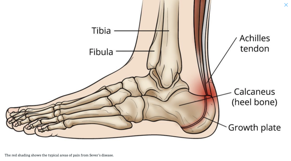 Sudden Ankle Pain Without an Injury: Causes and Treatment